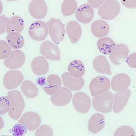Babesiosis
